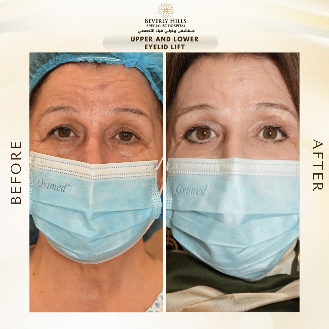 Eyelid Surgery